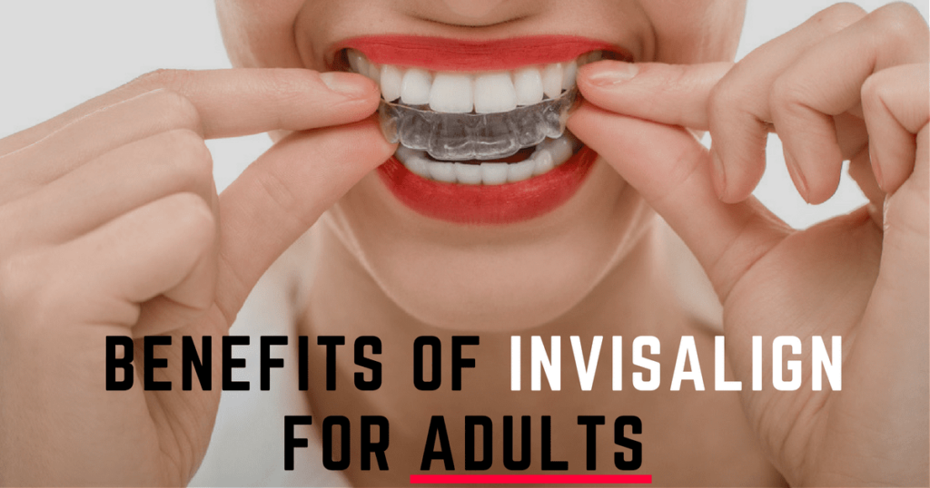 Benefits of Invisalign