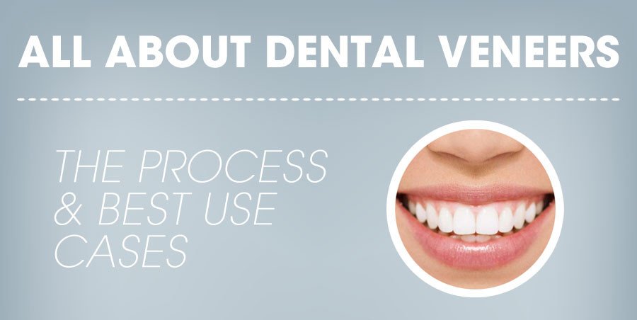 All About Porcelain Veneers